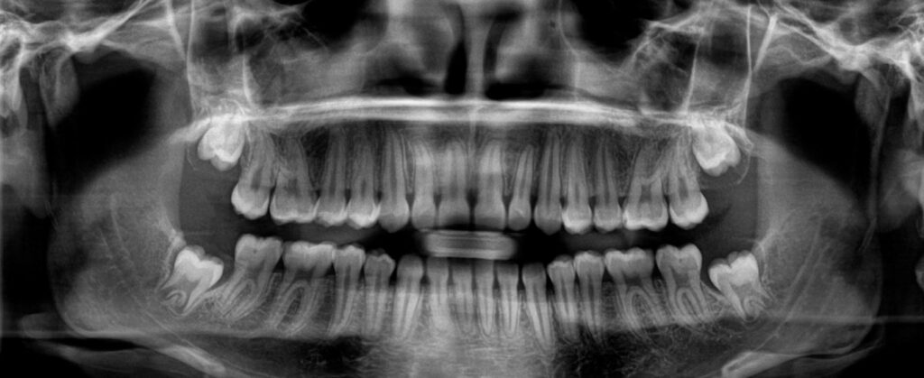 ¿Cuánto cuesta una radiografía dental? 2 cuanto cuesta una radiografia dental
