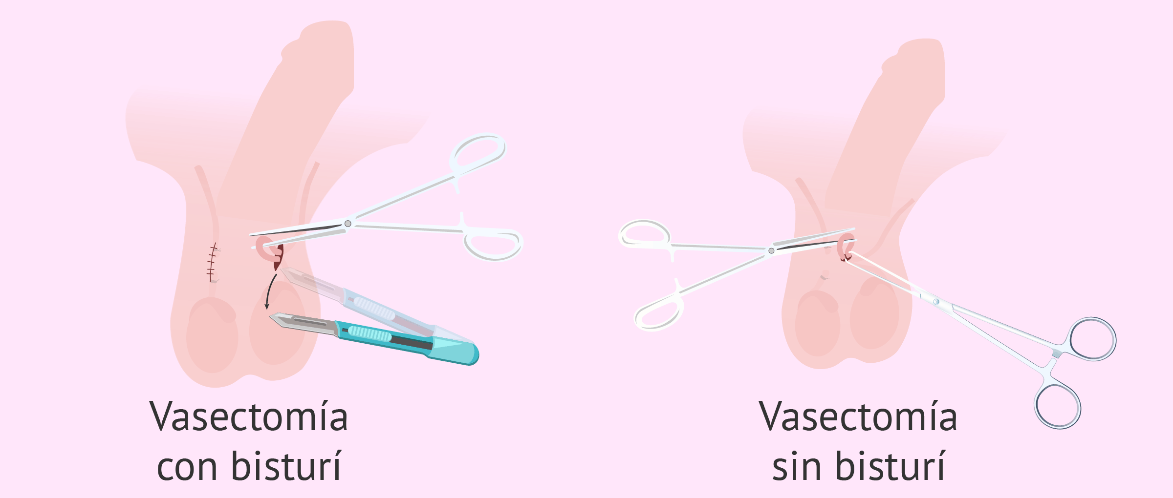 cuanto cuesta una vasectomia