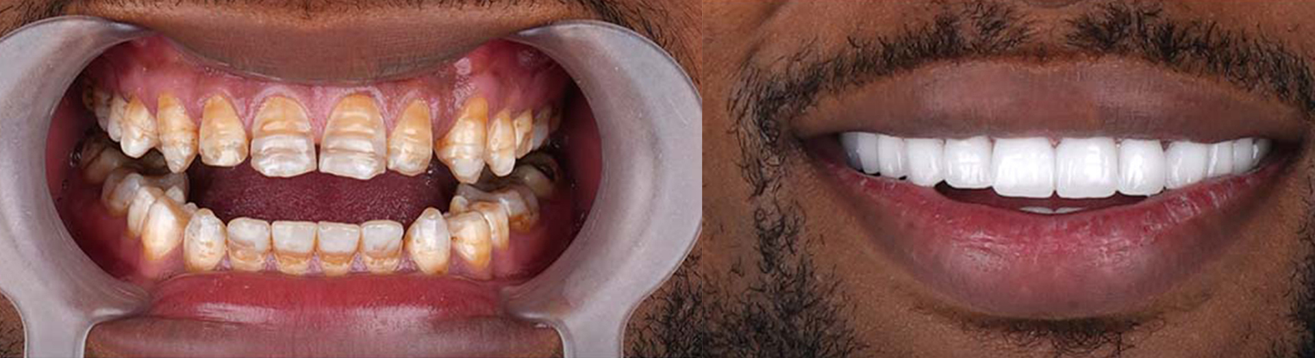 Blog 12 cuanto cuestan las carillas dentales
