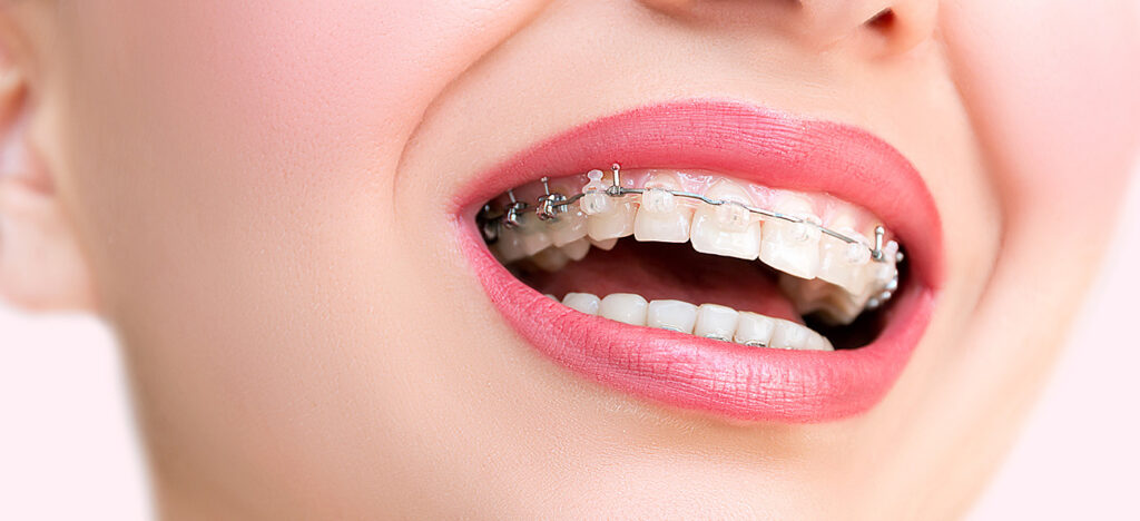Cuanto Cuestan Los Brackets 2 cuanto cuestan los brackets