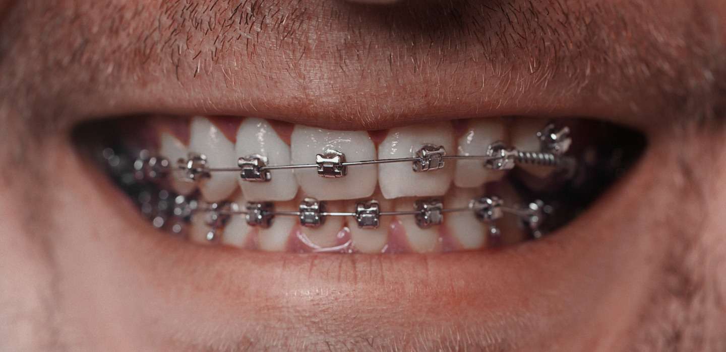 cuanto cuestan los brackets metalicos