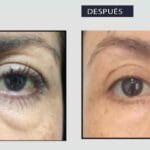 ¿Cuánto dura ácido hialurónico ojeras? cuanto-dura-acido-hialuronico-ojeras