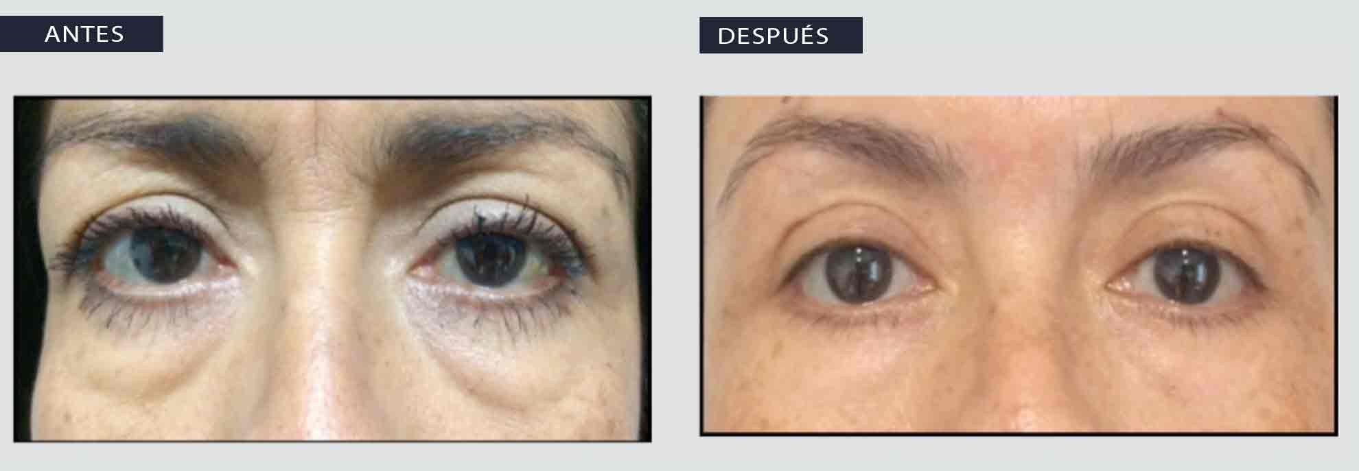 cuanto dura acido hialuronico ojeras