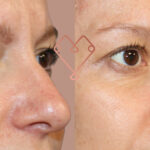 ¿Cuánto dura el botox? cuanto-dura-el-botox