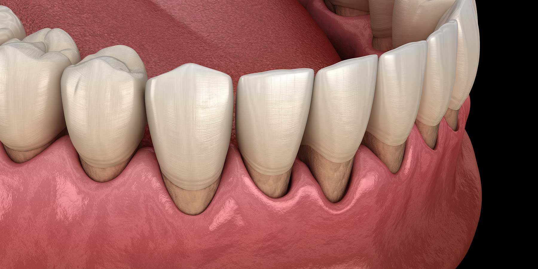Blog 8 cuanto dura la periodontitis