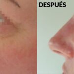 cuanto-dura-la-rinomodelacion