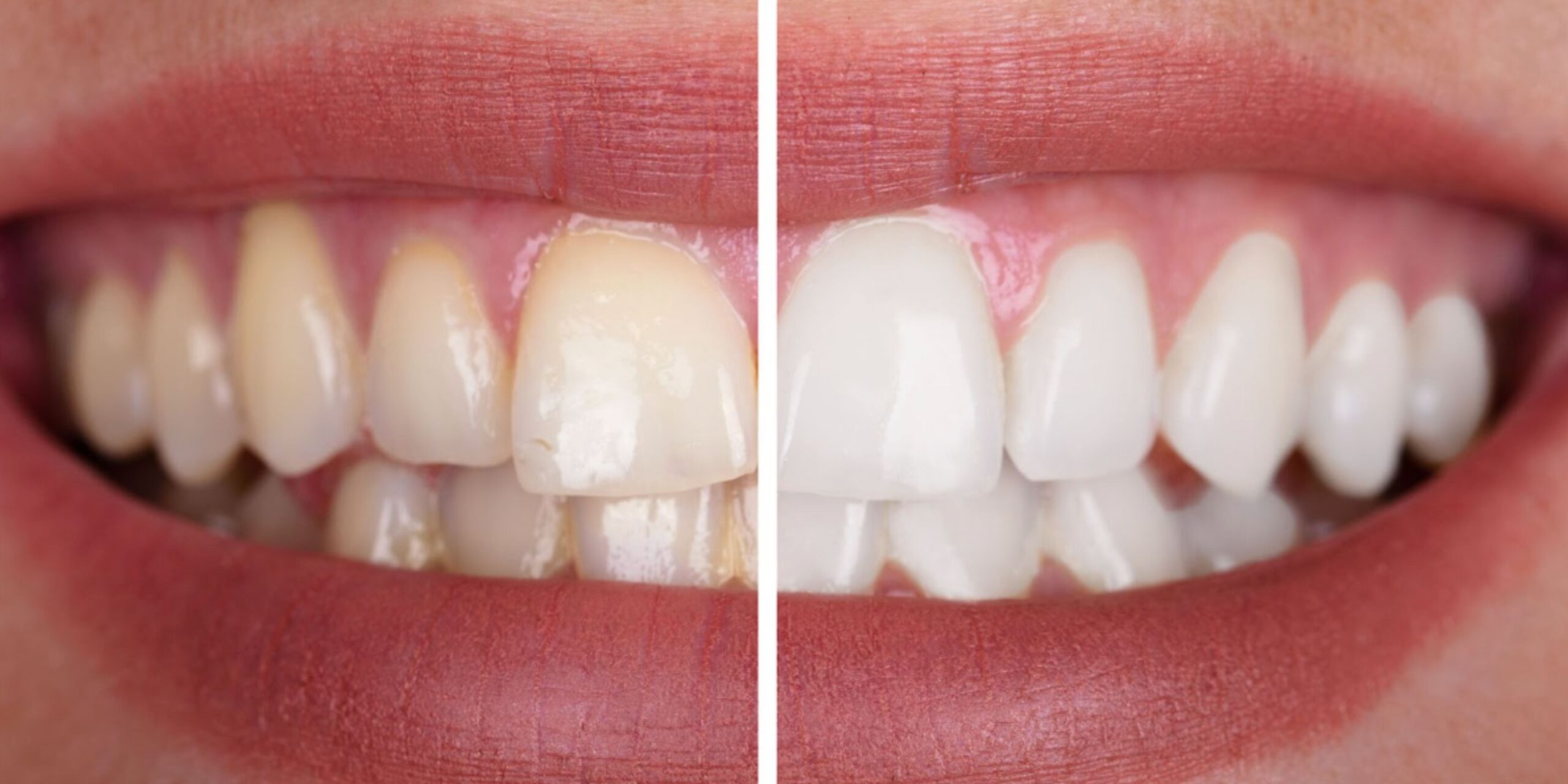 cuanto dura un blanqueamiento dental