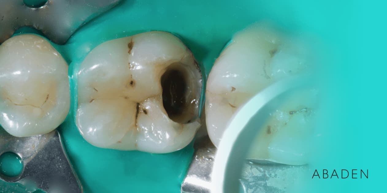 ¿Cuánto dura un empaste dental?