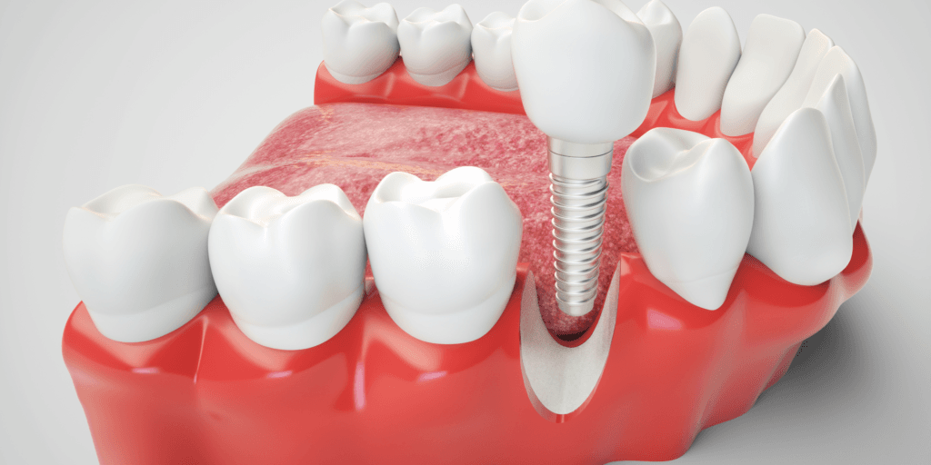 cuanto dura un implante dental