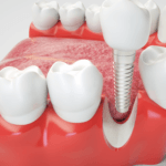 cuanto-dura-un-implante-dental