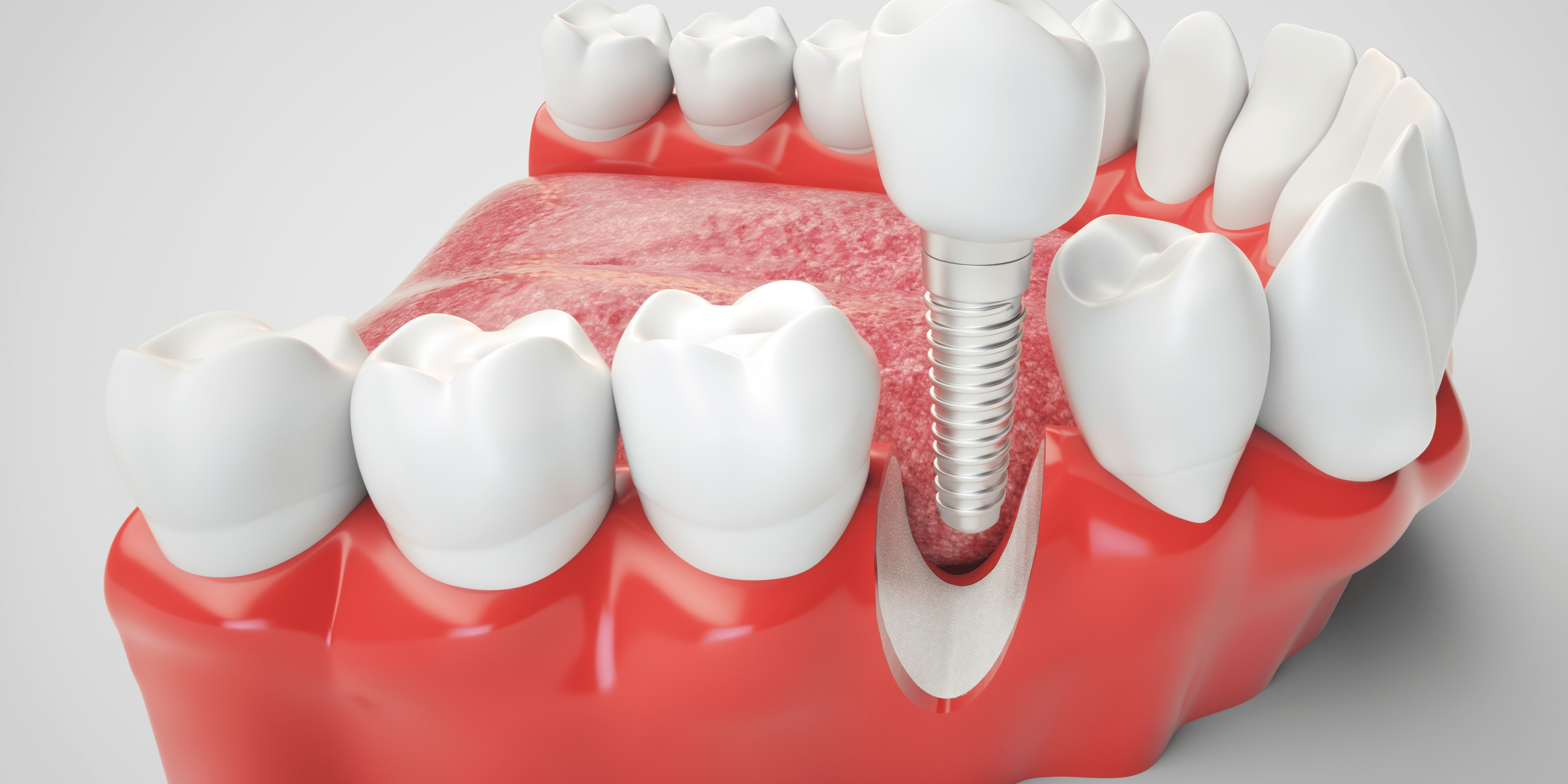 cuanto dura un implante dental