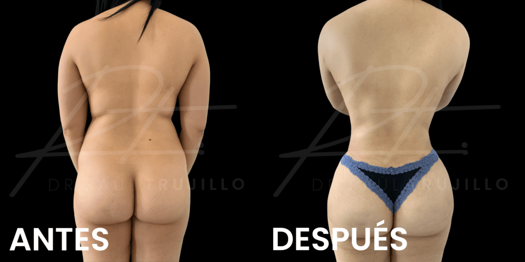 cuanto dura un mommy makeover