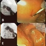 cuanto-dura-un-stent-biliar