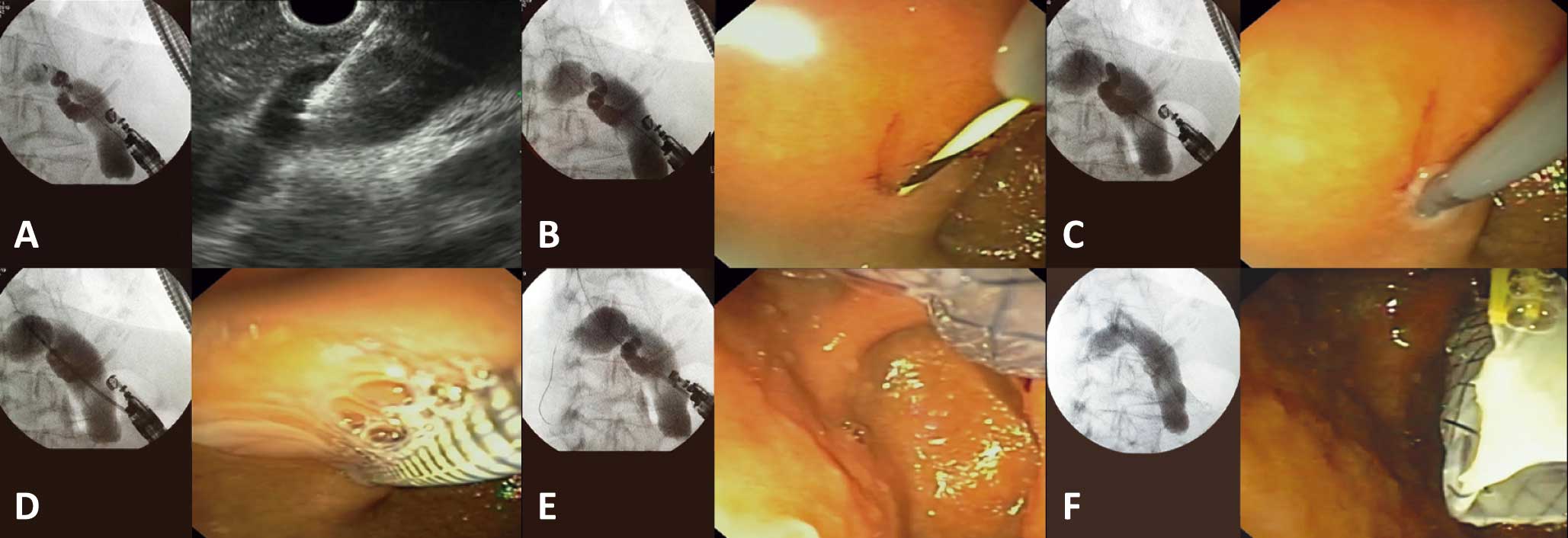 cuanto dura un stent biliar