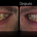 cuanto-dura-una-corona-dental