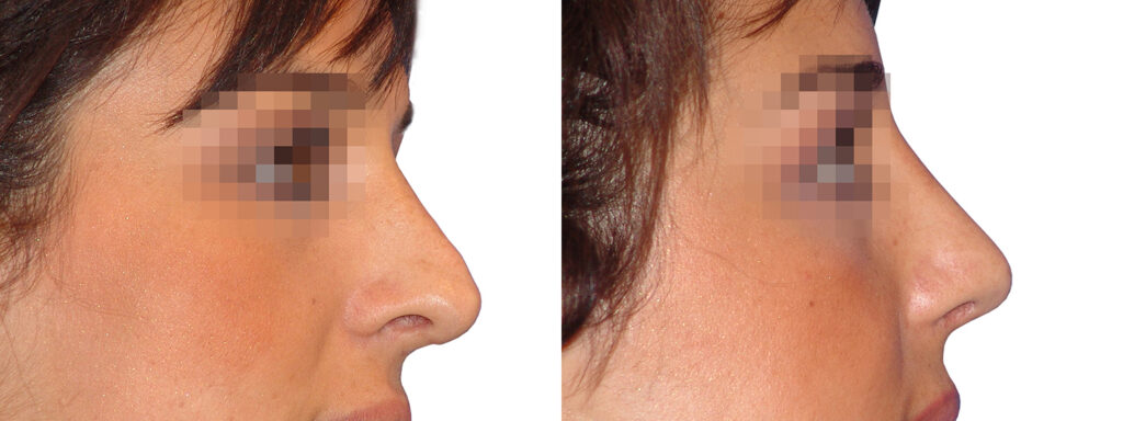 cuanto dura una rinoplastia