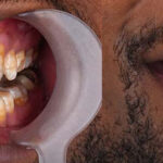 cuanto-duran-las-carillas-dentales