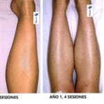 cuanto-sale-la-depilacion-laser