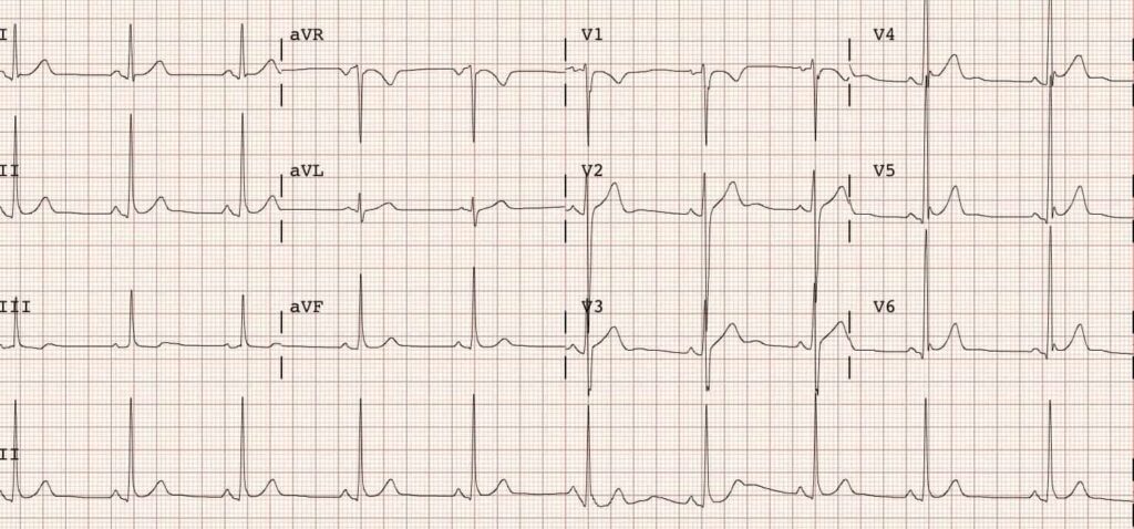 ¿Cuánto sale un electrocardiograma? 2 cuanto sale un electrocardiograma