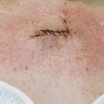 cuanto-sale-una-biopsia