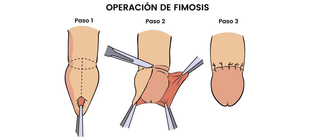 cuanto sale una circuncision