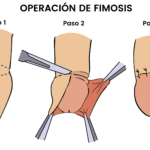 cuanto-sale-una-circuncision