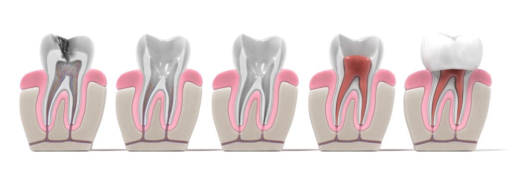 ¿Cuánto sale una endodoncia? 2 cuanto sale una endodoncia