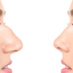 cuanto-sale-una-rinoplastia