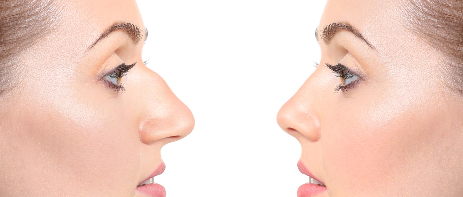cuanto sale una rinoplastia