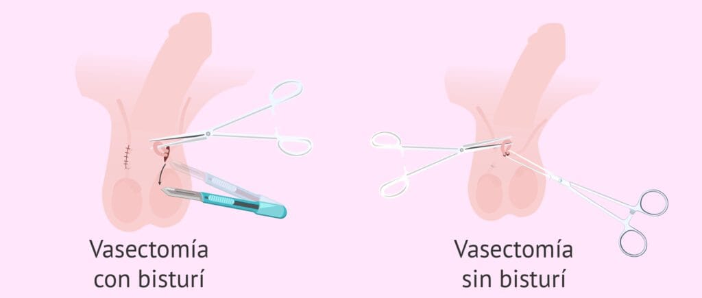 cuanto sale una vasectomia