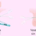 cuanto-sale-una-vasectomia