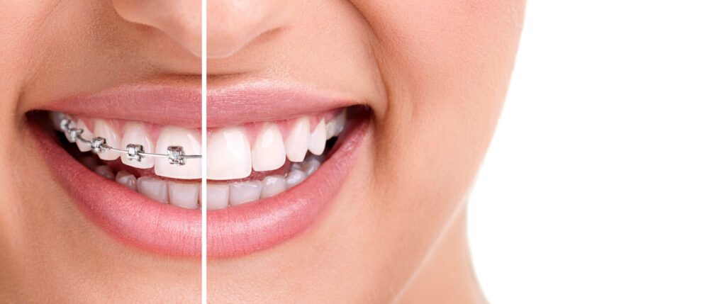 cuanto tardan en poner brackets