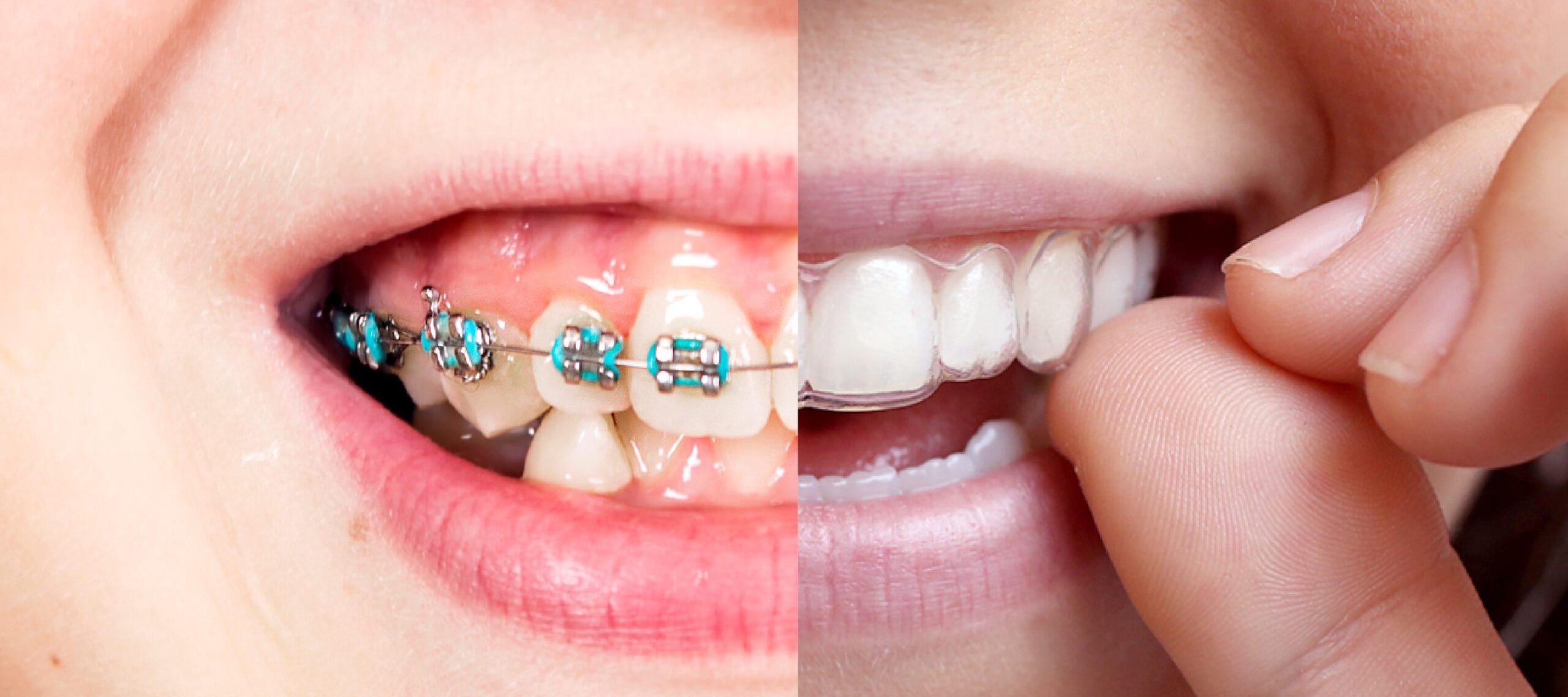 cuanto tiempo duelen los brackets scaled