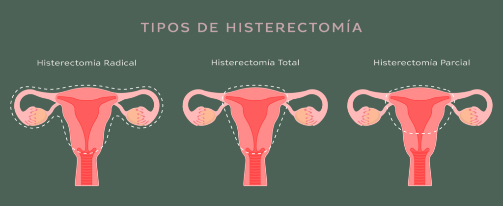 cuanto tiempo dura una histerectomia