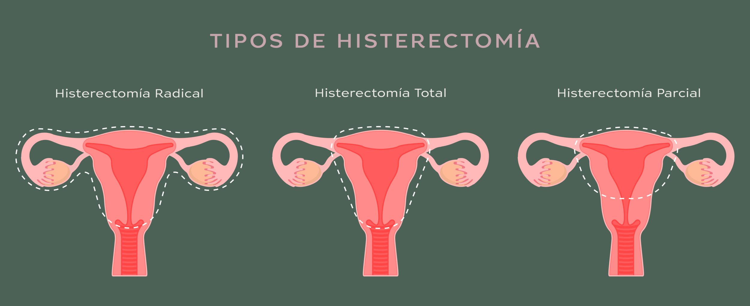 Blog 8 cuanto tiempo dura una histerectomia