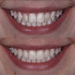 cuanto-tiempo-dura-una-resina