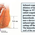 cuanto-tiempo-duran-las-hemorroides