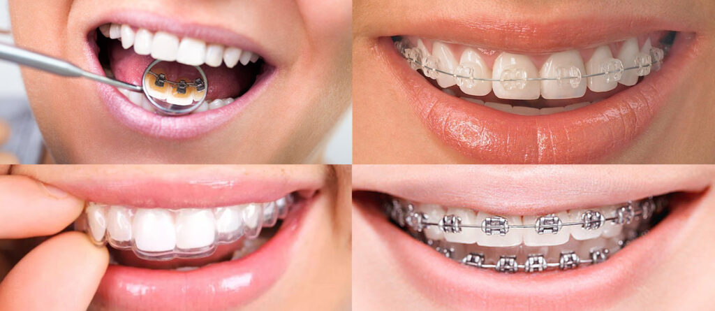 cuanto tiempo duran los brackets