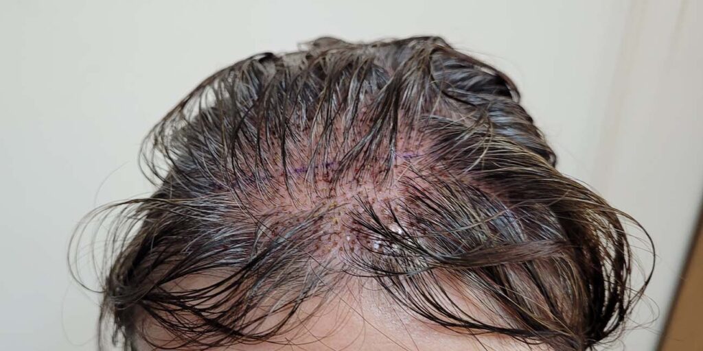 cuanto tiempo usar minoxidil