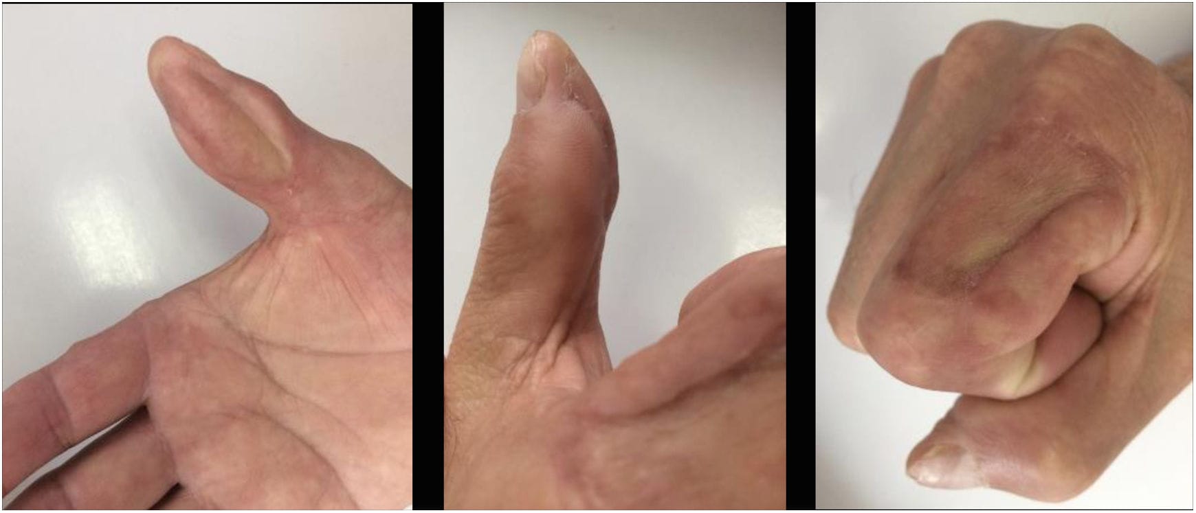 cuanto vale el dedo pulgar