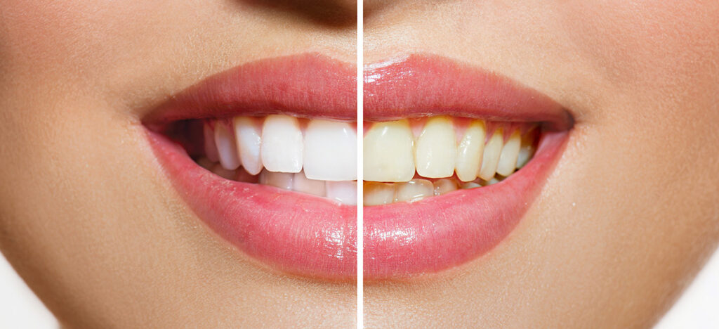cuanto vale un blanqueamiento dental