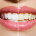 cuanto-vale-un-blanqueamiento-dental