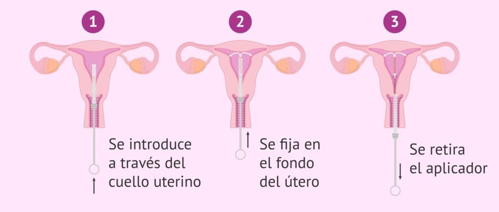 cuanto vale un diu