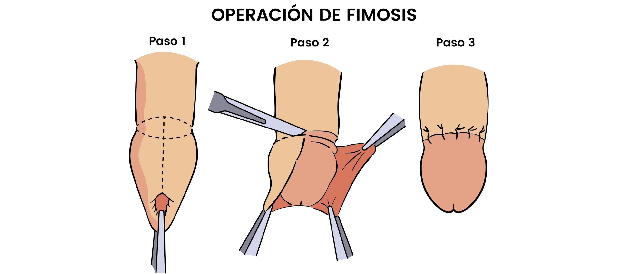 cuanto vale una circuncision