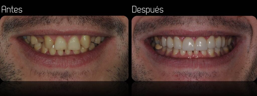 ¿Cuánto vale una incrustación dental? 2 cuanto vale una incrustacion dental