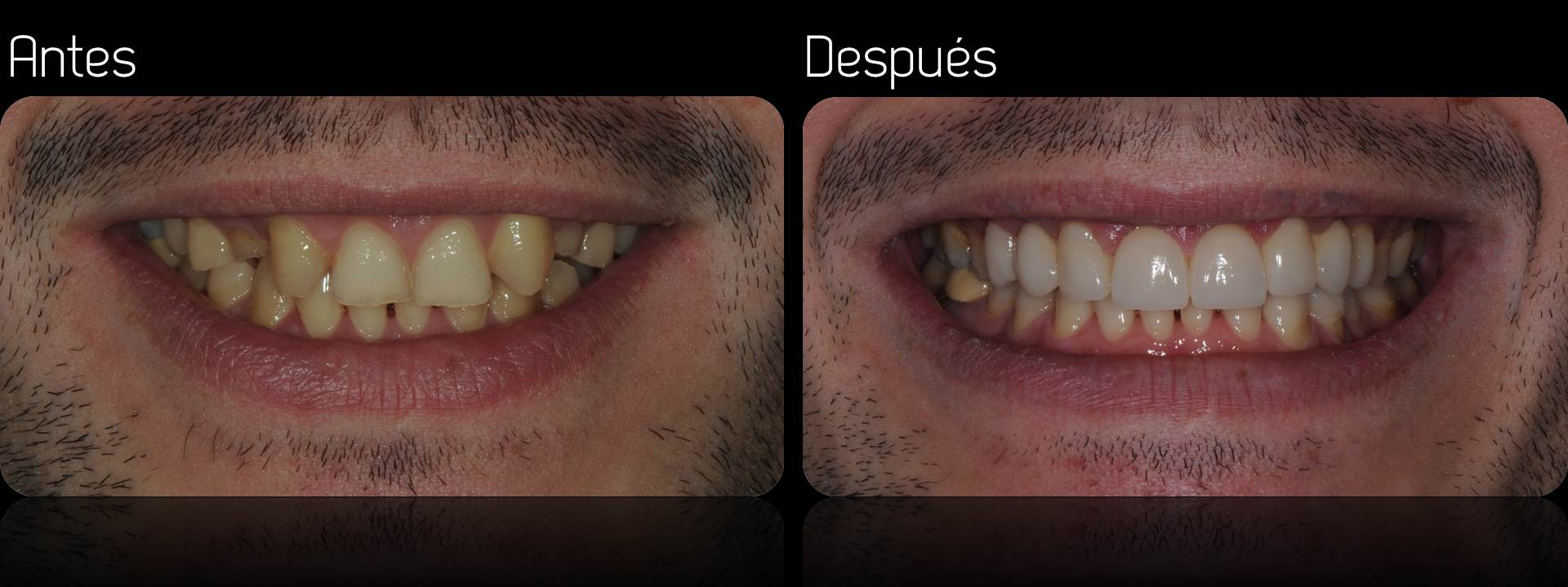 cuanto vale una incrustacion dental