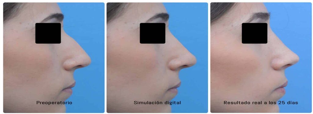 cuanto vale una rinoplastia