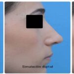 cuanto-vale-una-rinoplastia