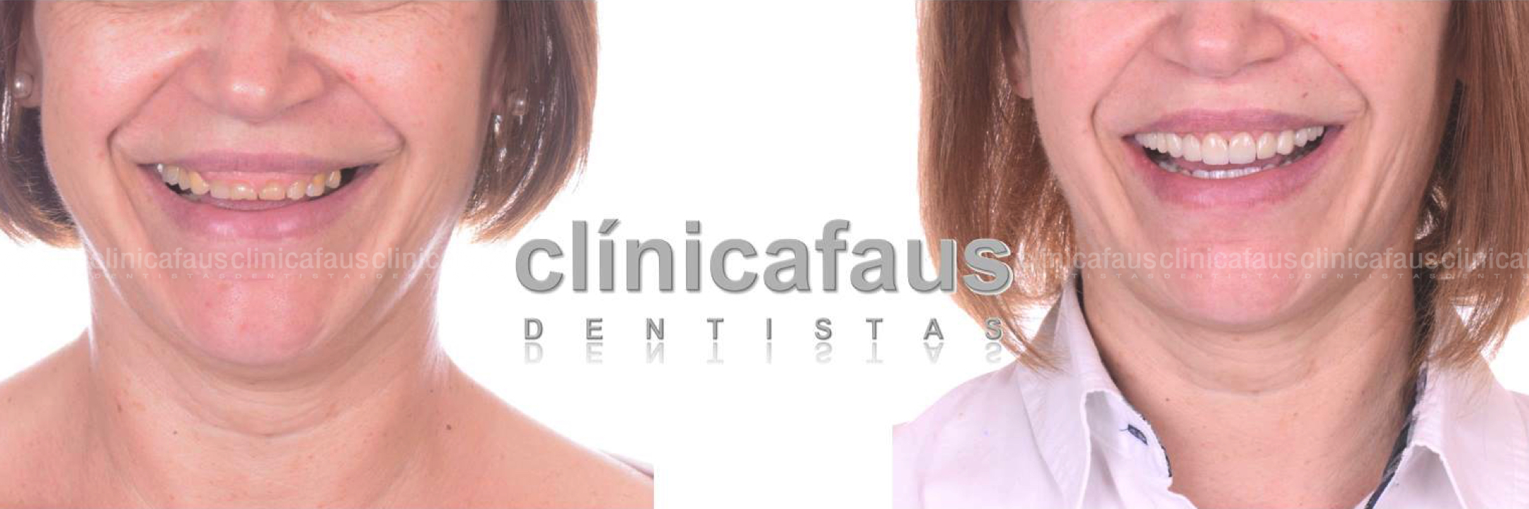 cuanto valen las carillas dentales