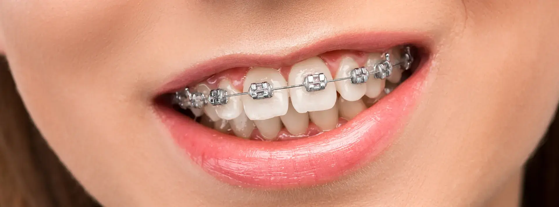 cuanto valen los brackets
